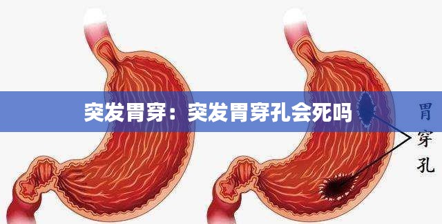 突发胃穿:突发胃穿孔会死吗